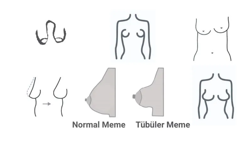 Tübüler Meme Nedir? - Tüberoz Meme nasıl görünür?