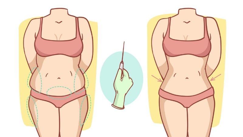 Annelik estetiği sırasında yapılan işlemler Antalya