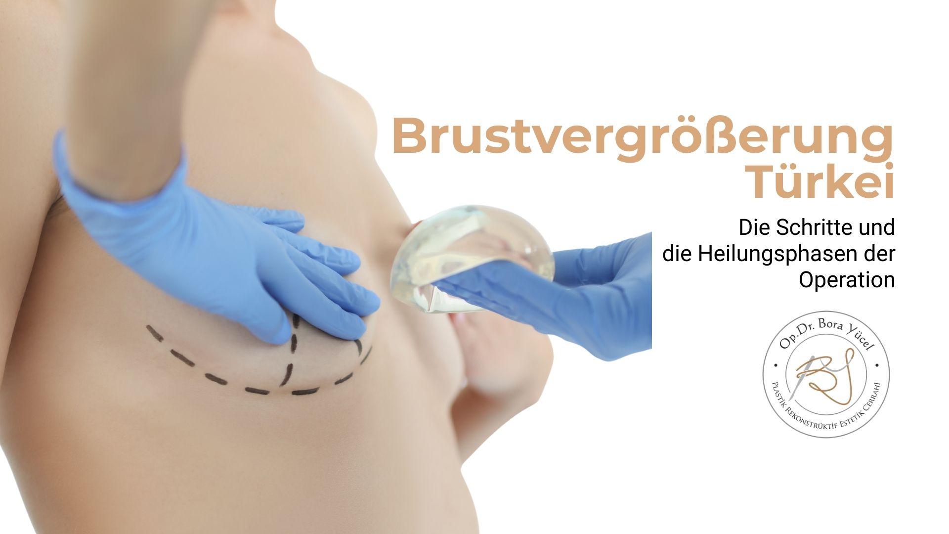 Was sind die Schritte einer Brustvergrößerung?
