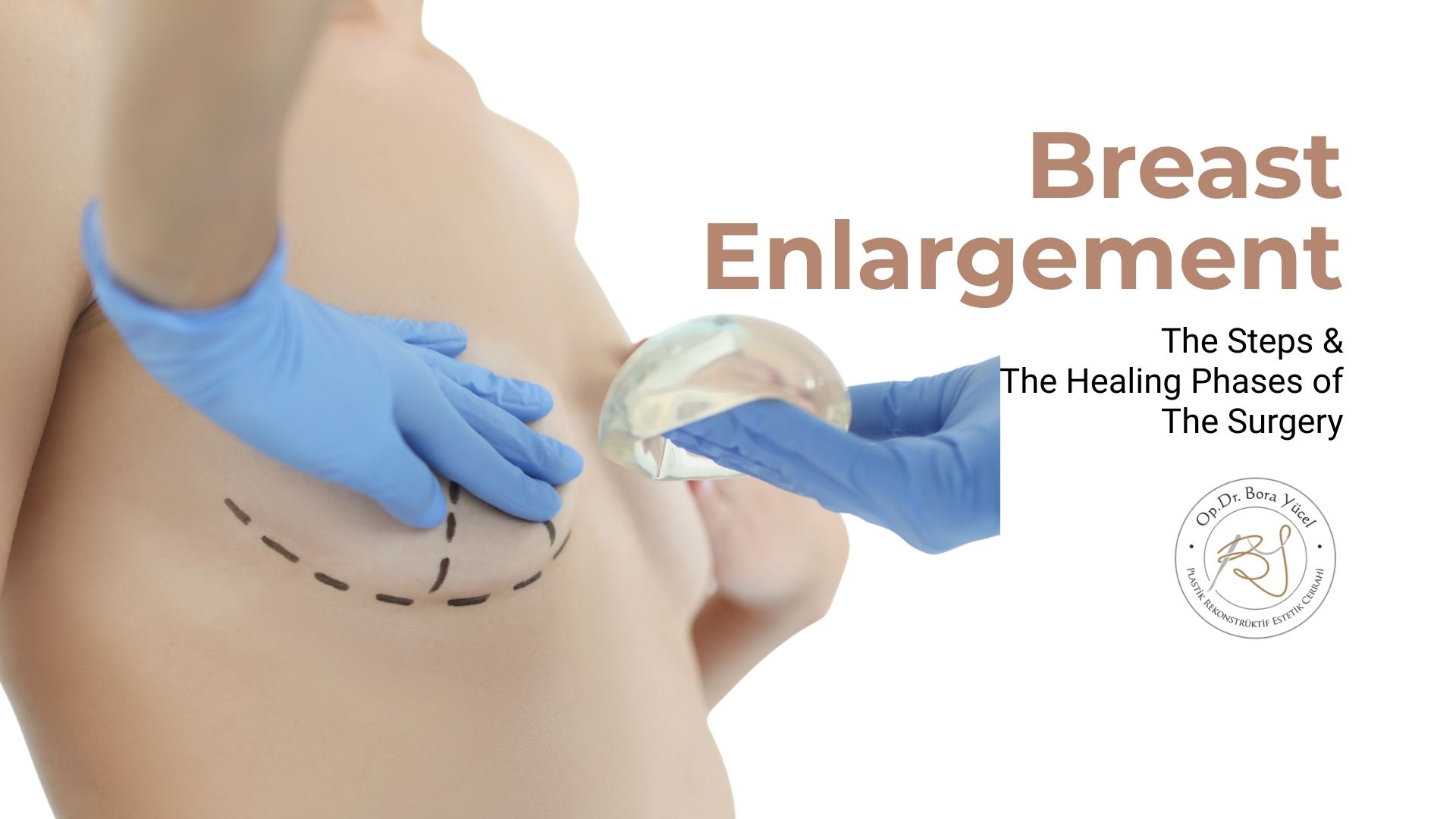 breast-augmentation-surgery-steps