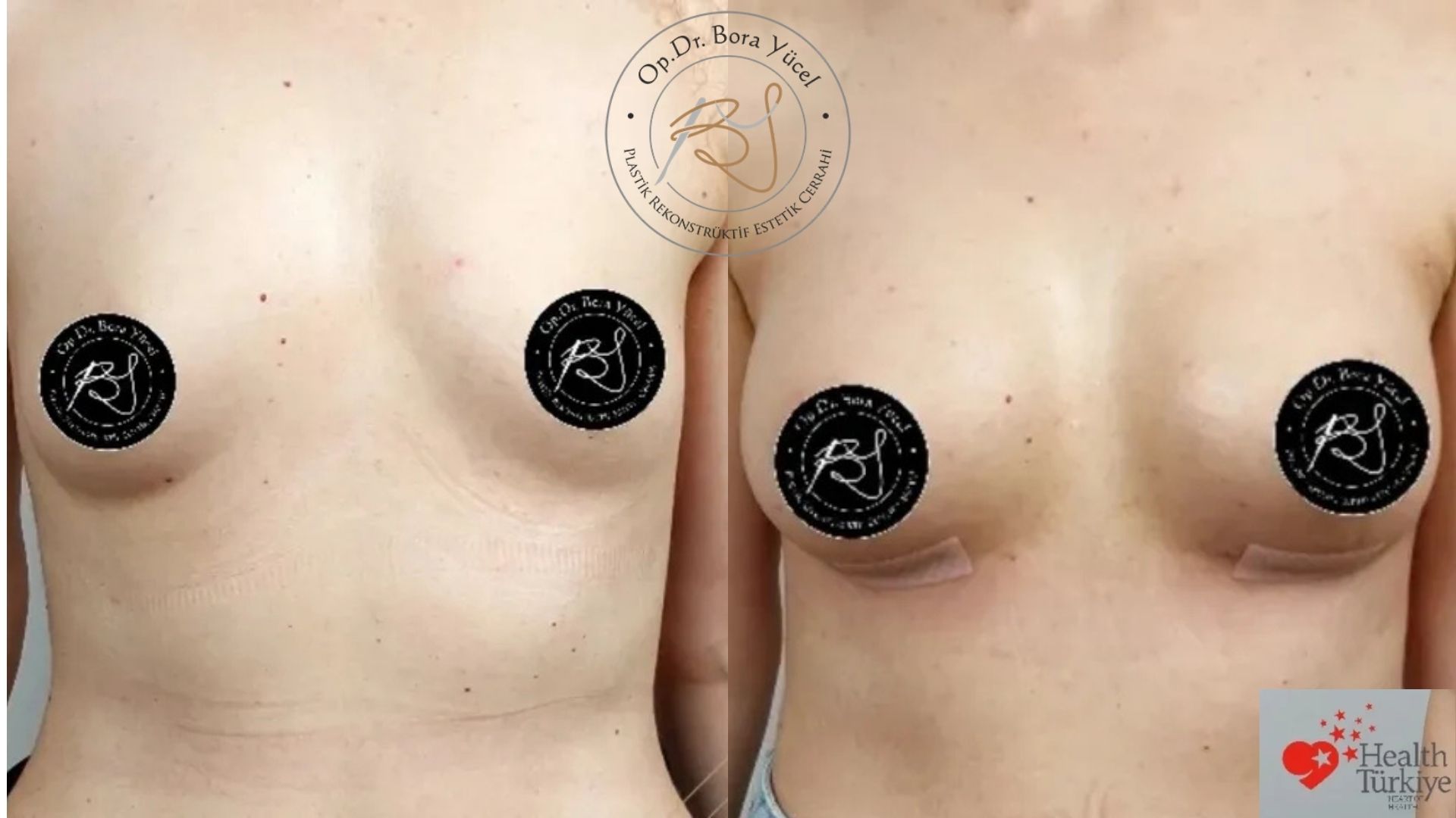 Breast Implants Before and After