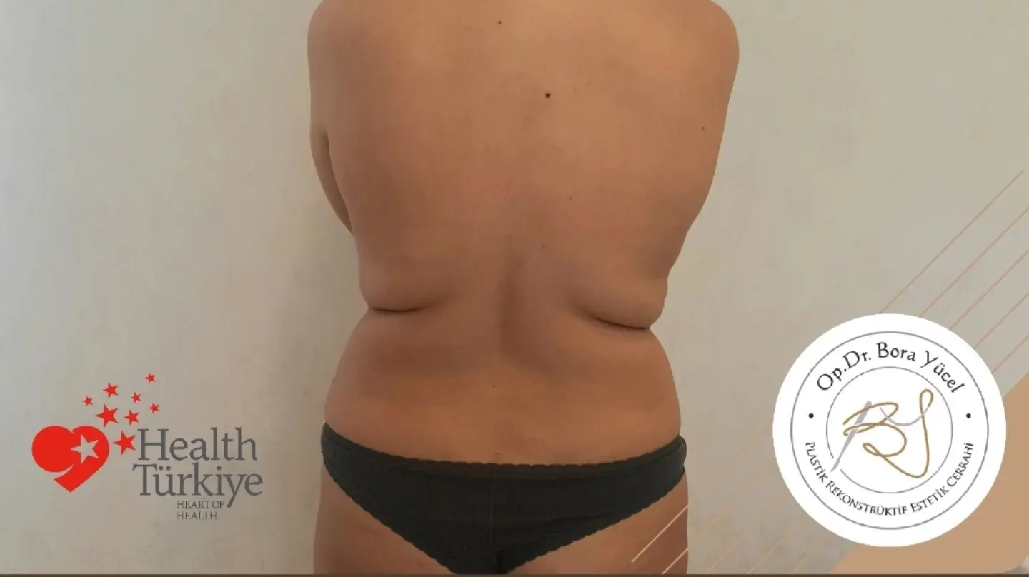 Liposuktion Vorher-Nachher in der Türkei, Antalya-1