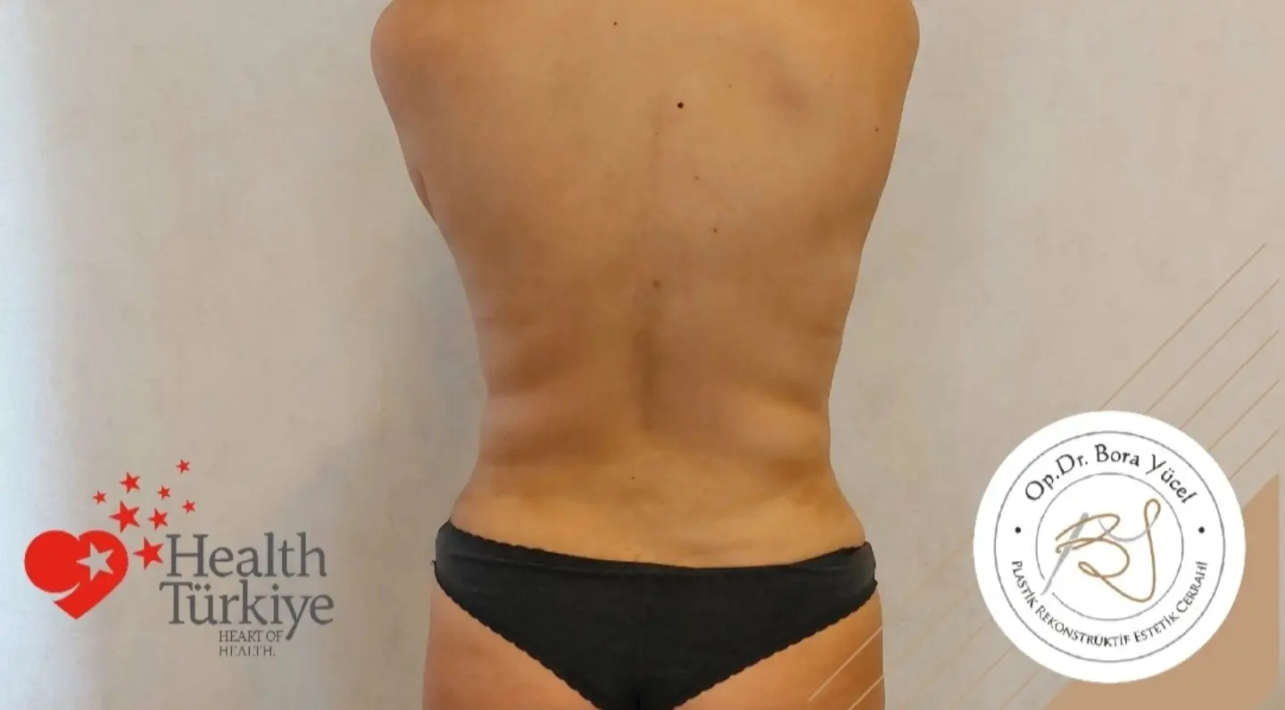 Liposuktion Vorher-Nachher in der Türkei, Antalya-2