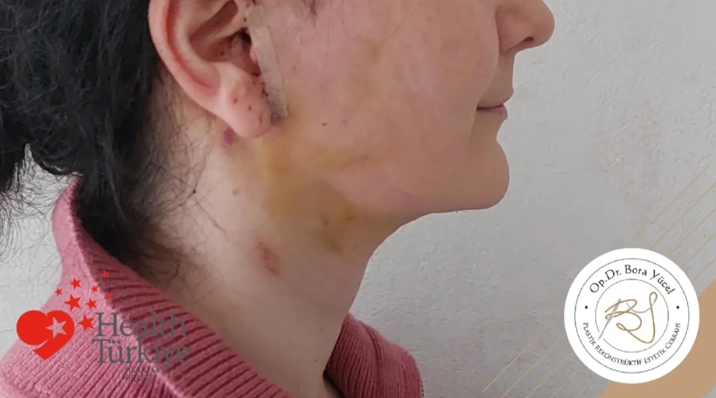 jawline-treatment-turkey-antalya-after