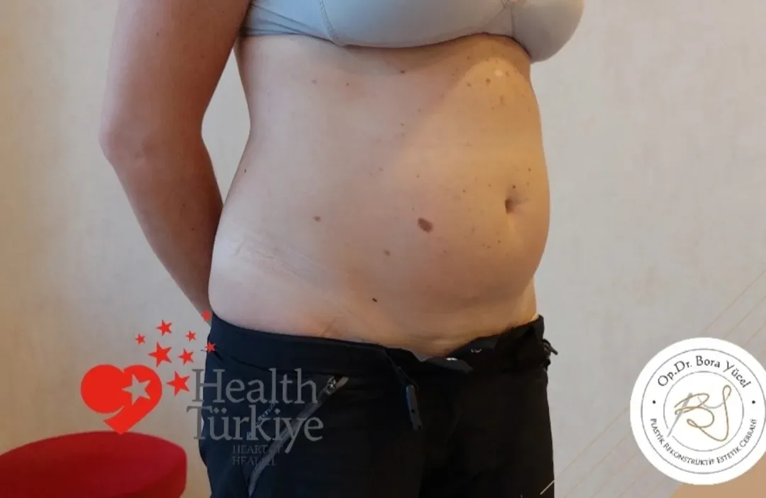 liposuction before and after turkey-3