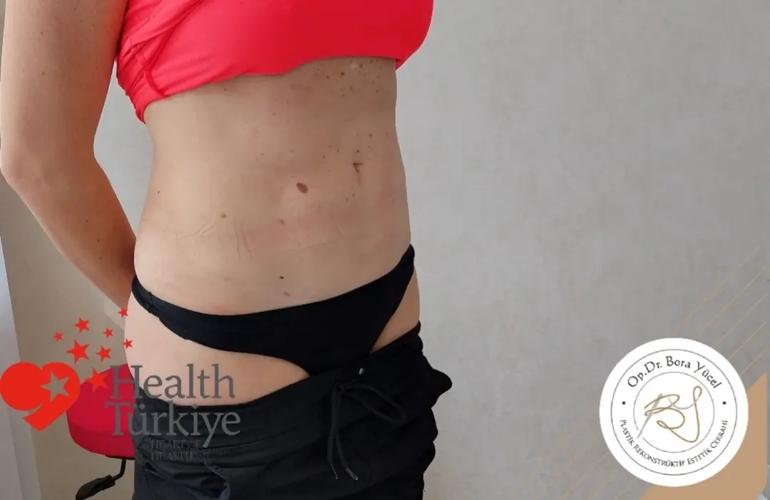 liposuction before and after turkey-4