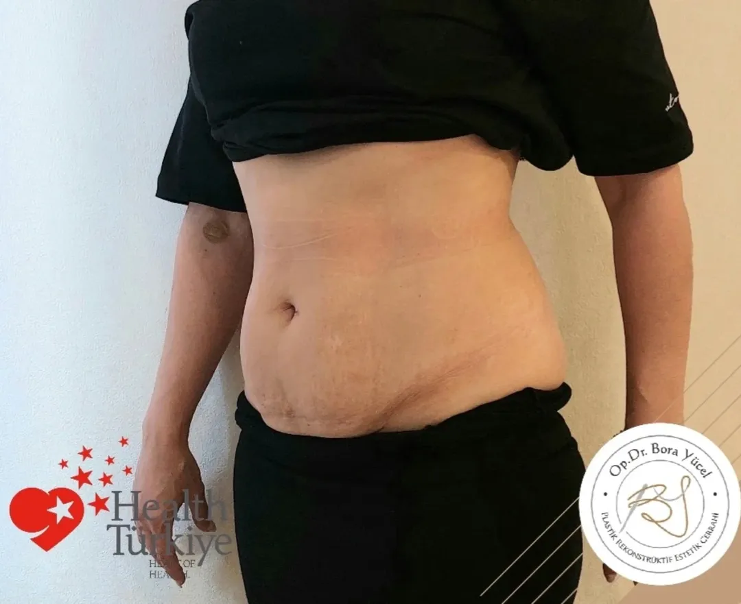 Mini Tummy Tuck (Mini Abdominoplasty) before