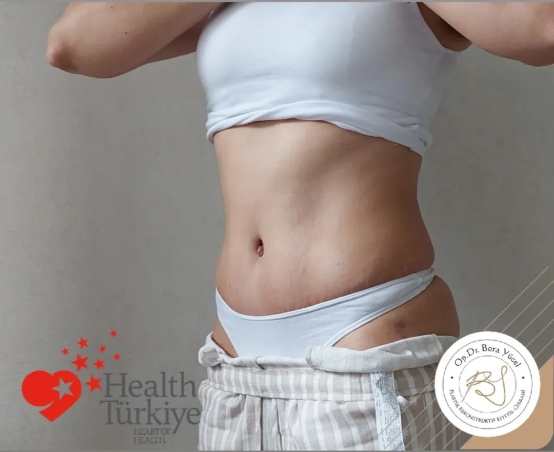 Mini Tummy Tuck (Mini Abdominoplasty) after