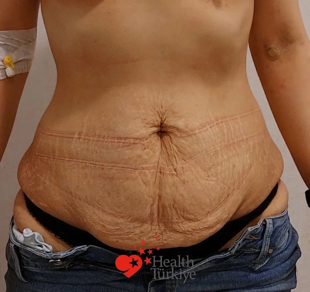 Mini Tummy Tuck (Mini Abdominoplasty) before