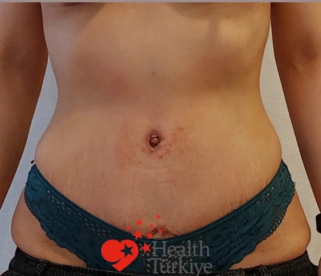 Mini Tummy Tuck (Mini Abdominoplasty) after