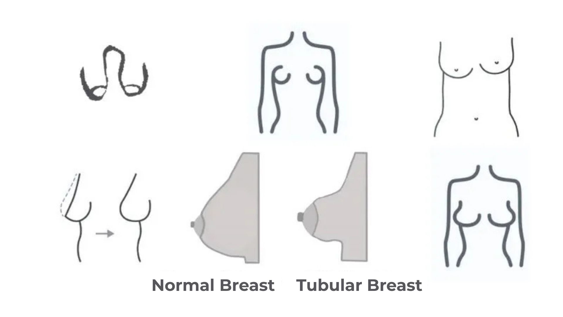 the symptoms of tubular breast