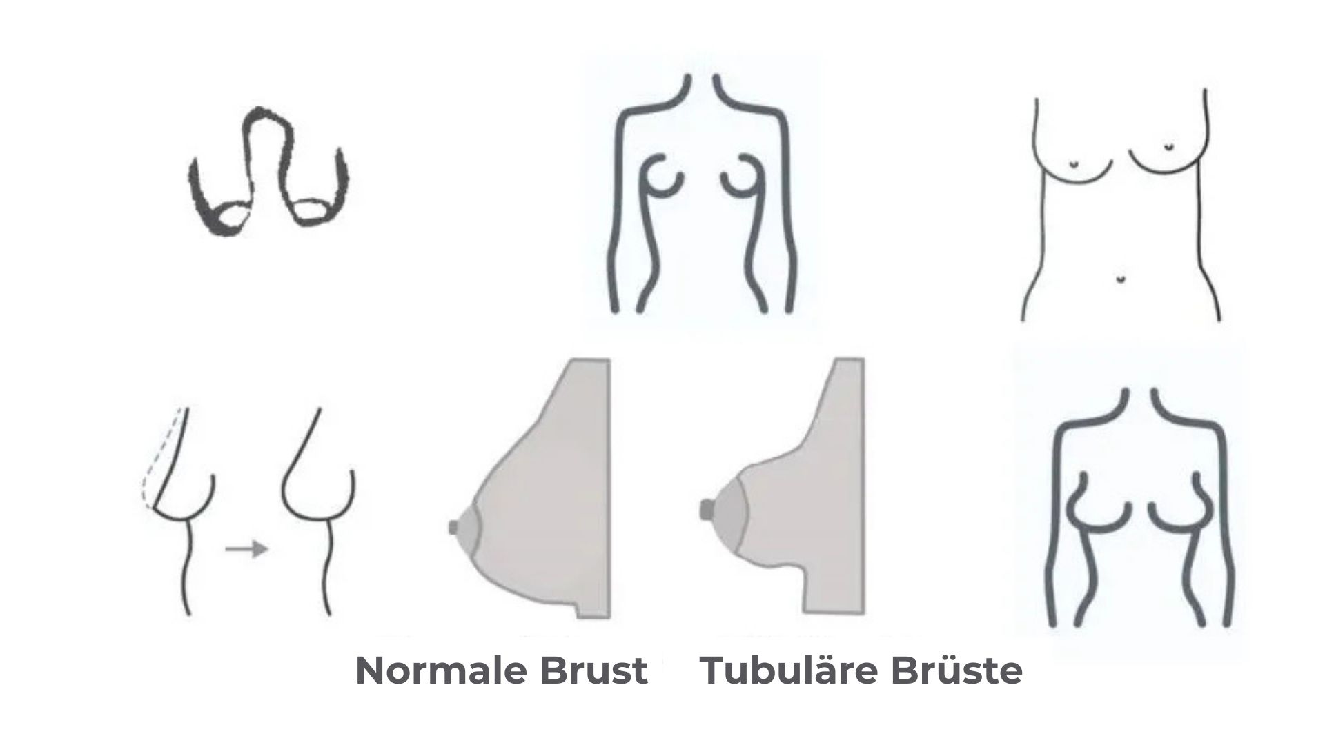 Die Symptome von tubulären Brüsten