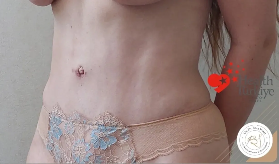 Bauchdeckenstraffung nachher