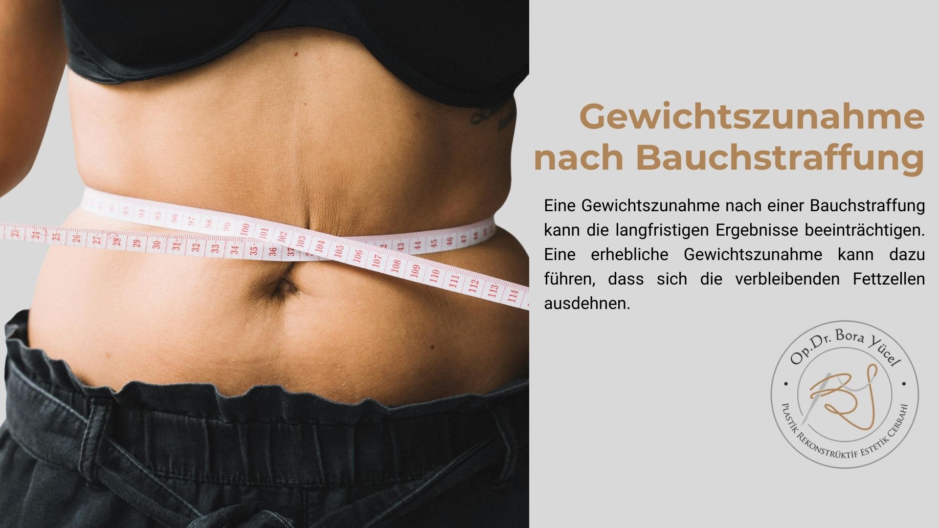 Gewichtszunahme nach Bauchstraffung 