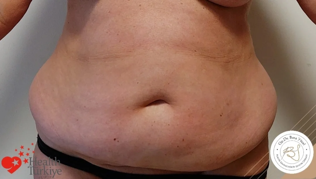 liposuction and tummy-tuck before
