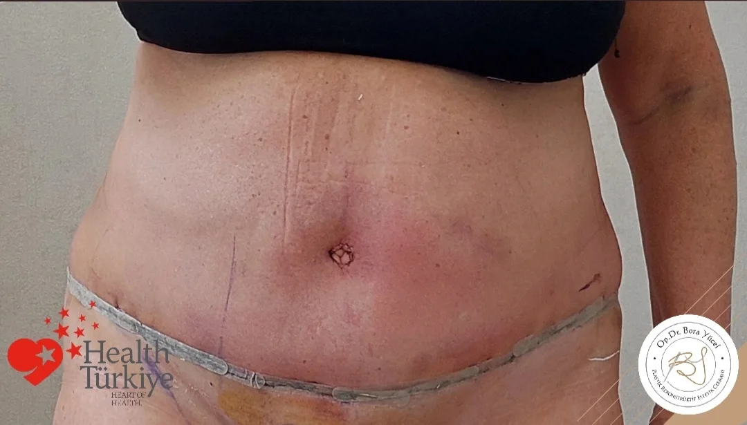 liposuction and tummy-tuck after