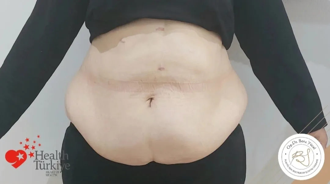 liposuction and tummy-tuck before