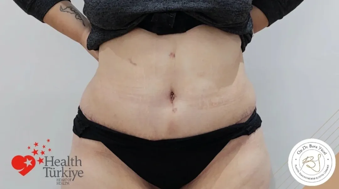 liposuction and tummy-tuck after