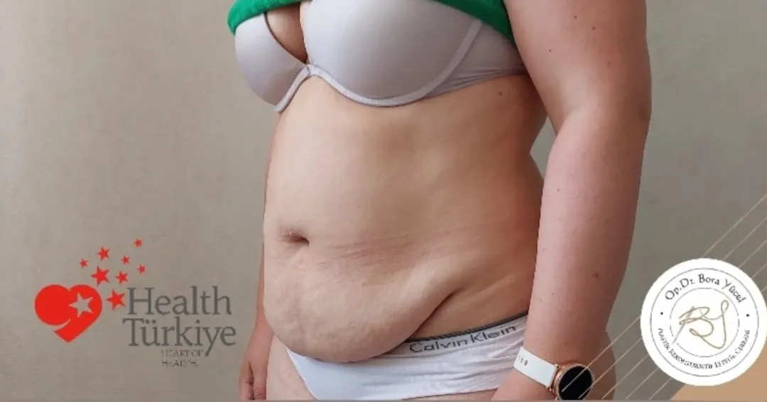 liposuction and tummy-tuck before