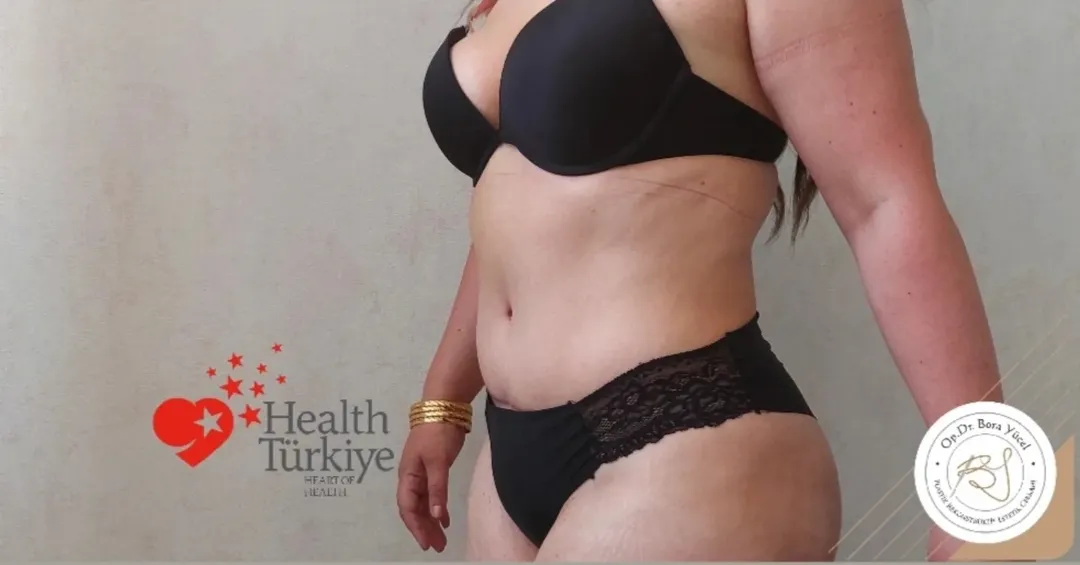 liposuction and tummy-tuck after