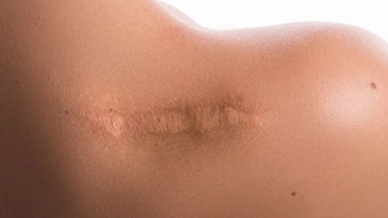 Skar revizyonu sonrası iyileşme süreci Antalya