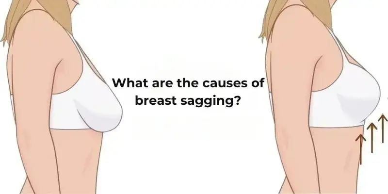 Causes of breast sagging