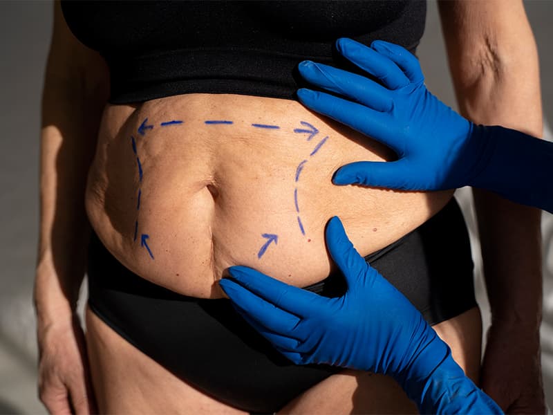 Dümdüz Bir Karın için abdominoplasti - Antalya