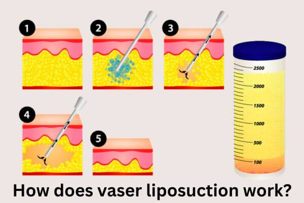 what is vaser liposuction?