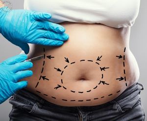antalya liposuction