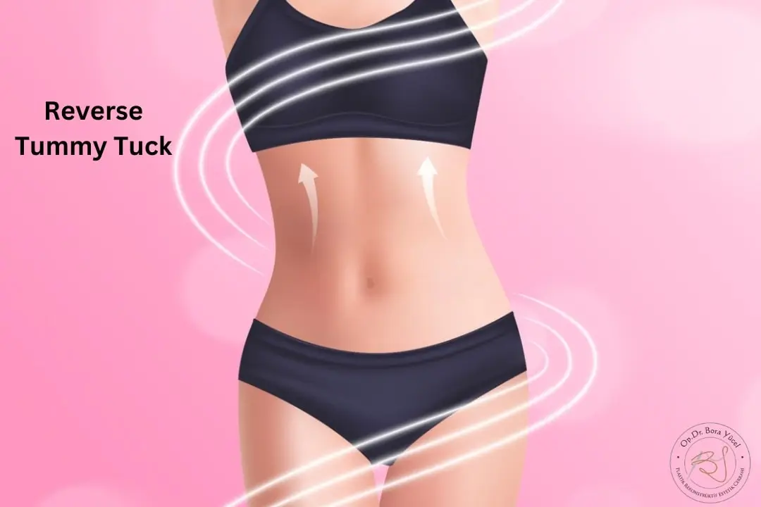 Reverse tummy tuck (abdominoplasty)