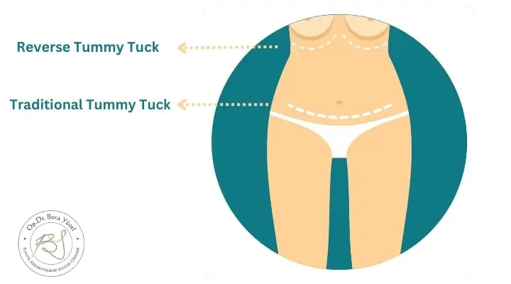 Reverse tummy tuck vs traditional tummy tuck in Turkey