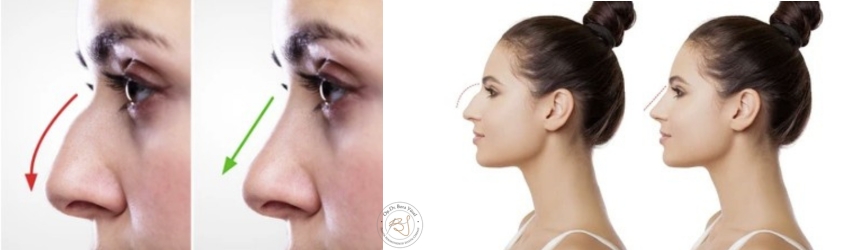 Antalya Nasenkorrektur - Rhinoplastik Vorher Nachher