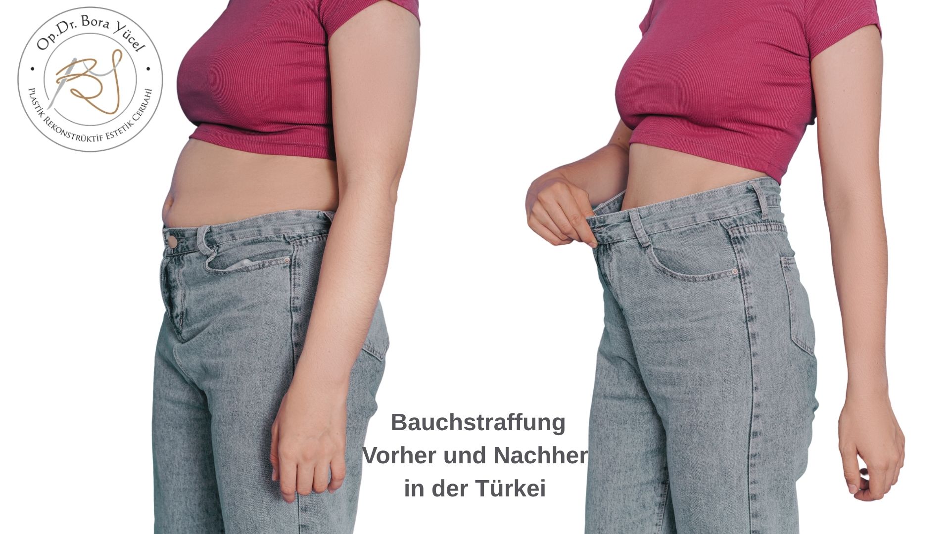 Bauchstraffung vorher und nachher