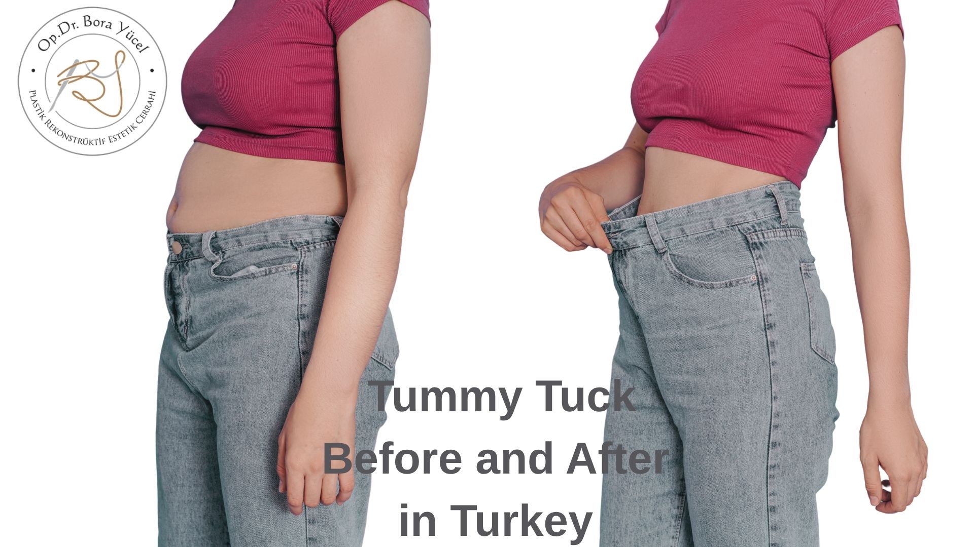 tummy-tuck-before-and-after-turkey