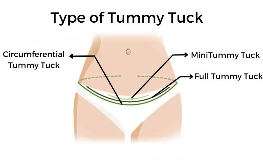 antalya Tummy Tuck - Abdominoplasty