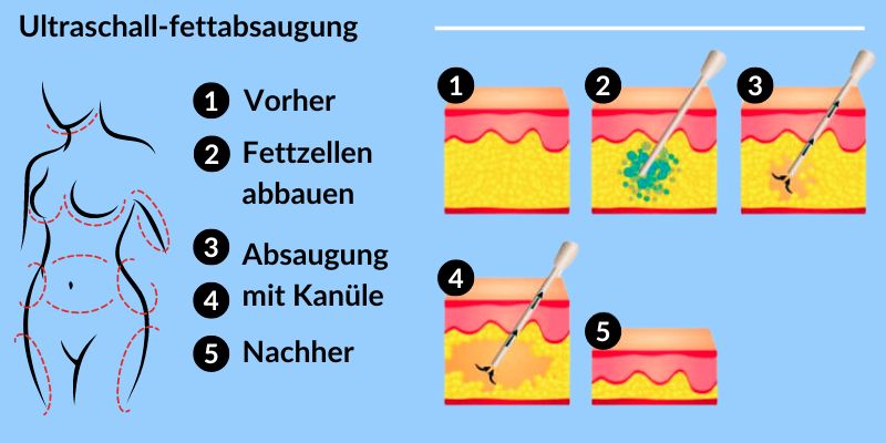 Krähenfüße