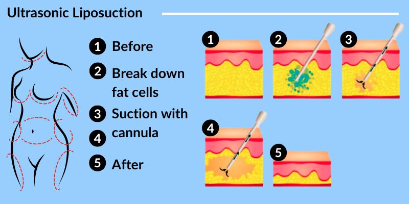 Does Ultrasonic Liposuction Really Work?