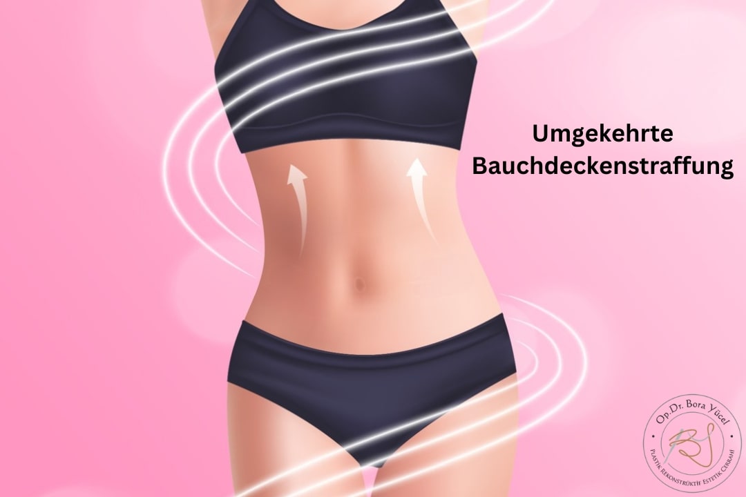 Umgekehrte Bauchdeckenstraffung