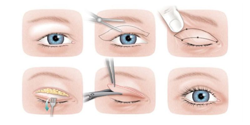 Alt üst göz kapağı ameliyatı avantajı  Antalya