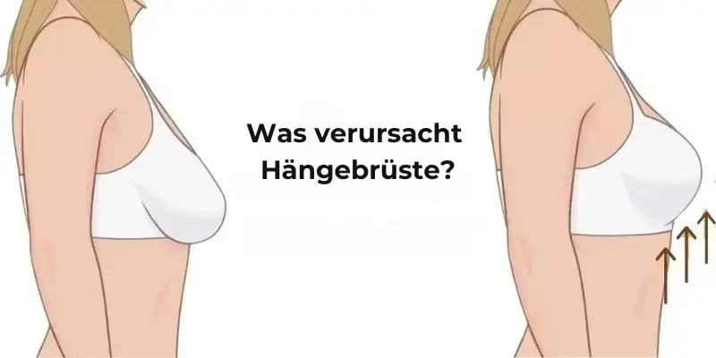 Was verursacht Hängebrüste?