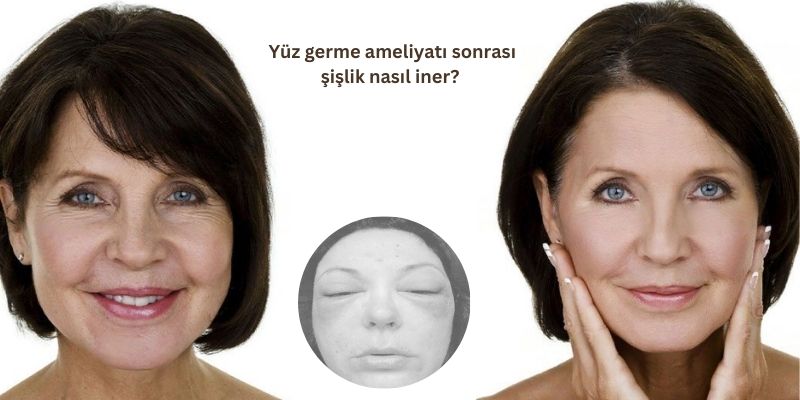 Yüz germe ameliyatı sonrası şişlik nasıl iner? 